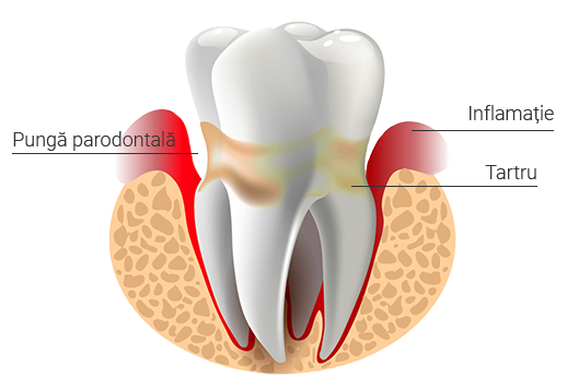 dinte parodontoza