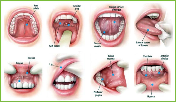 Cancerul oral – simptome, tratament